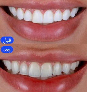 نمونه کار دکتر فاطمه جلیلیان دندانپزشک