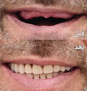 نمونه کار کاشت دندان دکتر امیرحسین کرمی