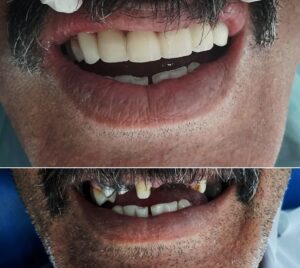 نمونه کار ایمپلنت دکتر محمد ناصری