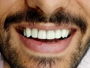 نمونه کار لمینت دکتر محمد ناصری