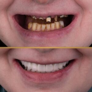 نمونه ایمپلنت دکتر قشقایی