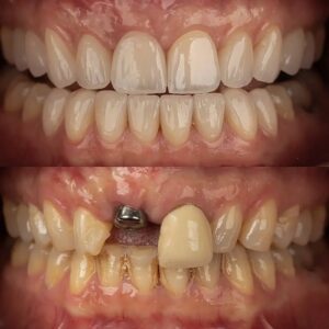 نمونه ایمپلنت دکتر قشقایی