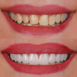 نمونه لمینت دکتر قشقایی