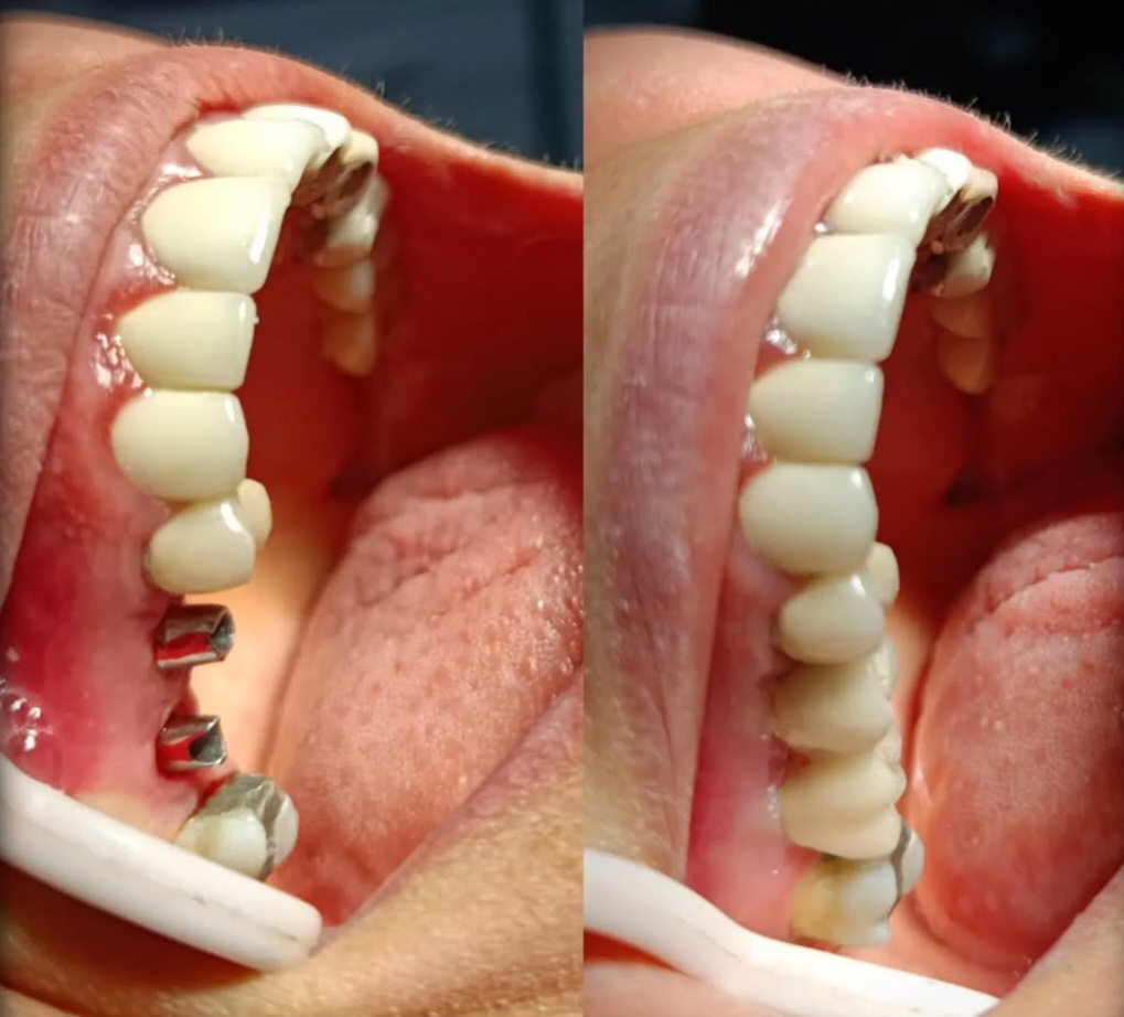 نمونه کار ایمپلنت دکتر فرید سلیمانی