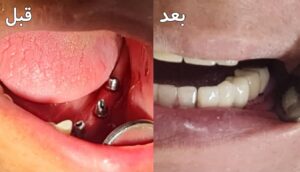 نمونه کار ایمپلنت دکتر گلاره همتی