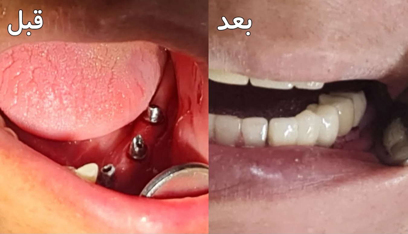 نمونه کار ایمپلنت دکتر گلاره همتی