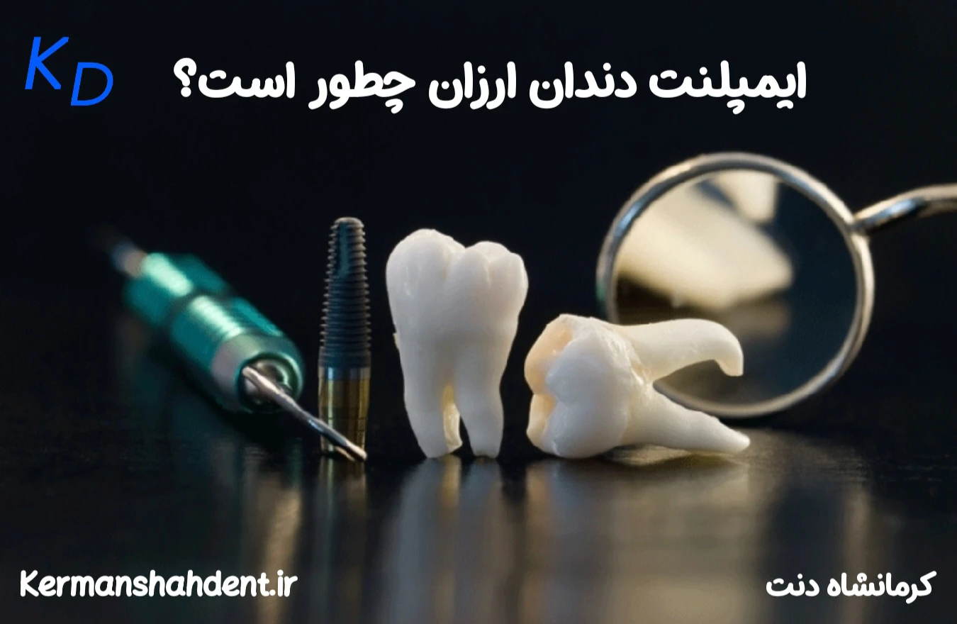 انجام ایمپلنت ارزان