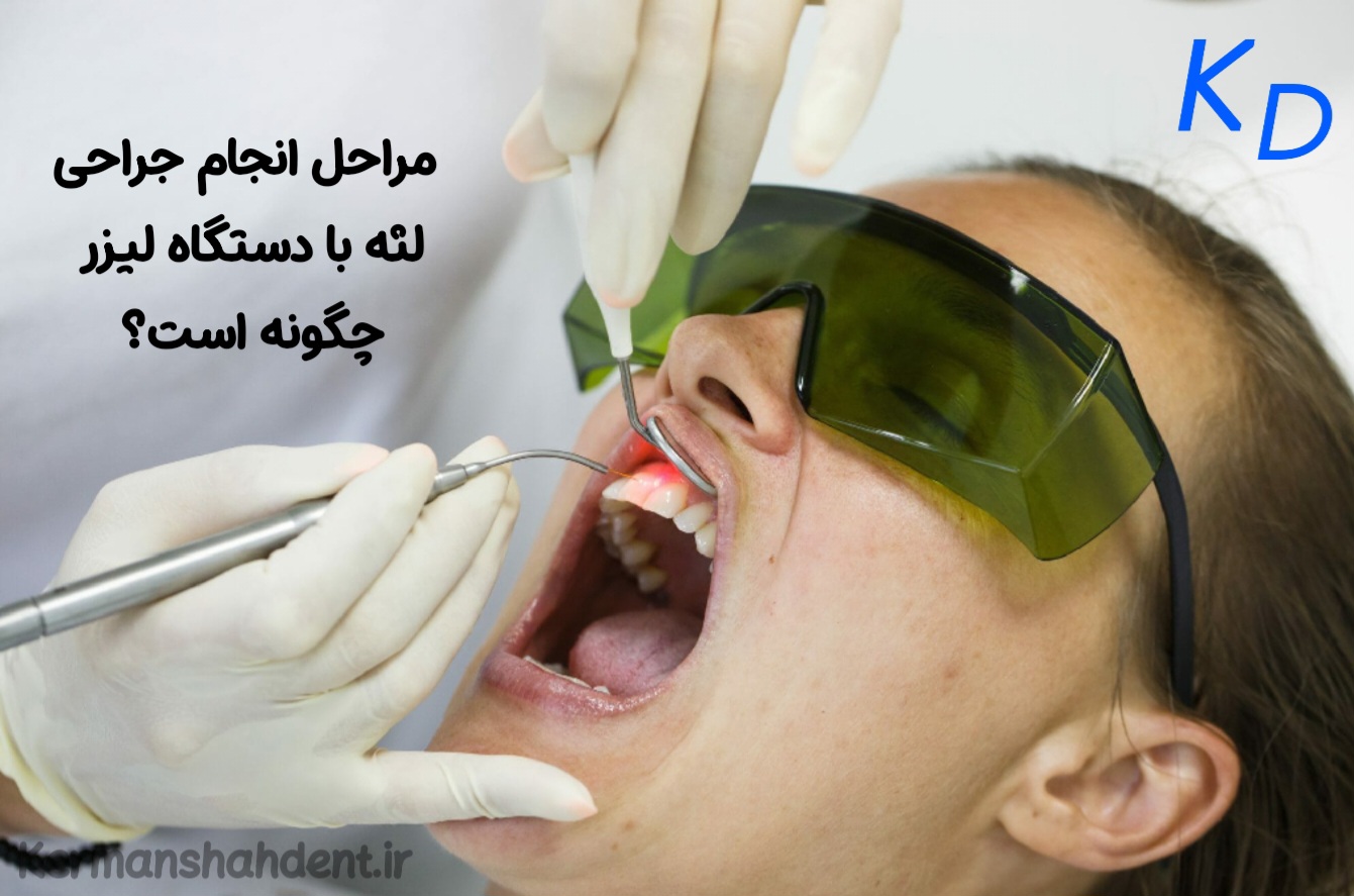 مراحل انجام جراحی لثه با لیزر