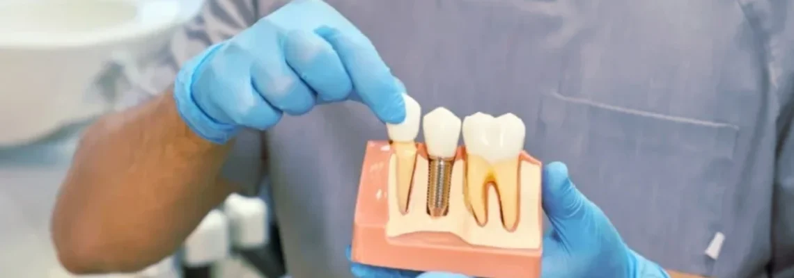 ایمپلنت دندان در کرمانشاه