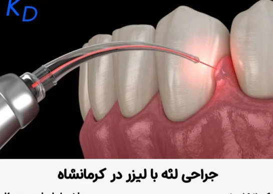 جراحی لثه با لیزر در کرمانشاه