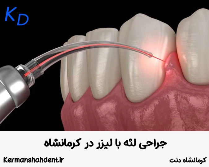 جراحی لثه با لیزر در کرمانشاه