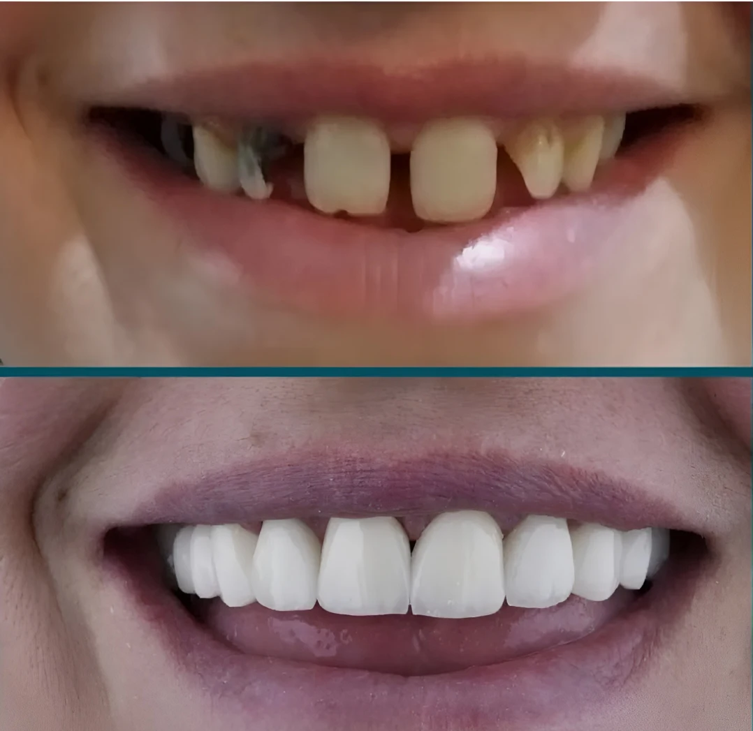 فاصله بین دندان چیست