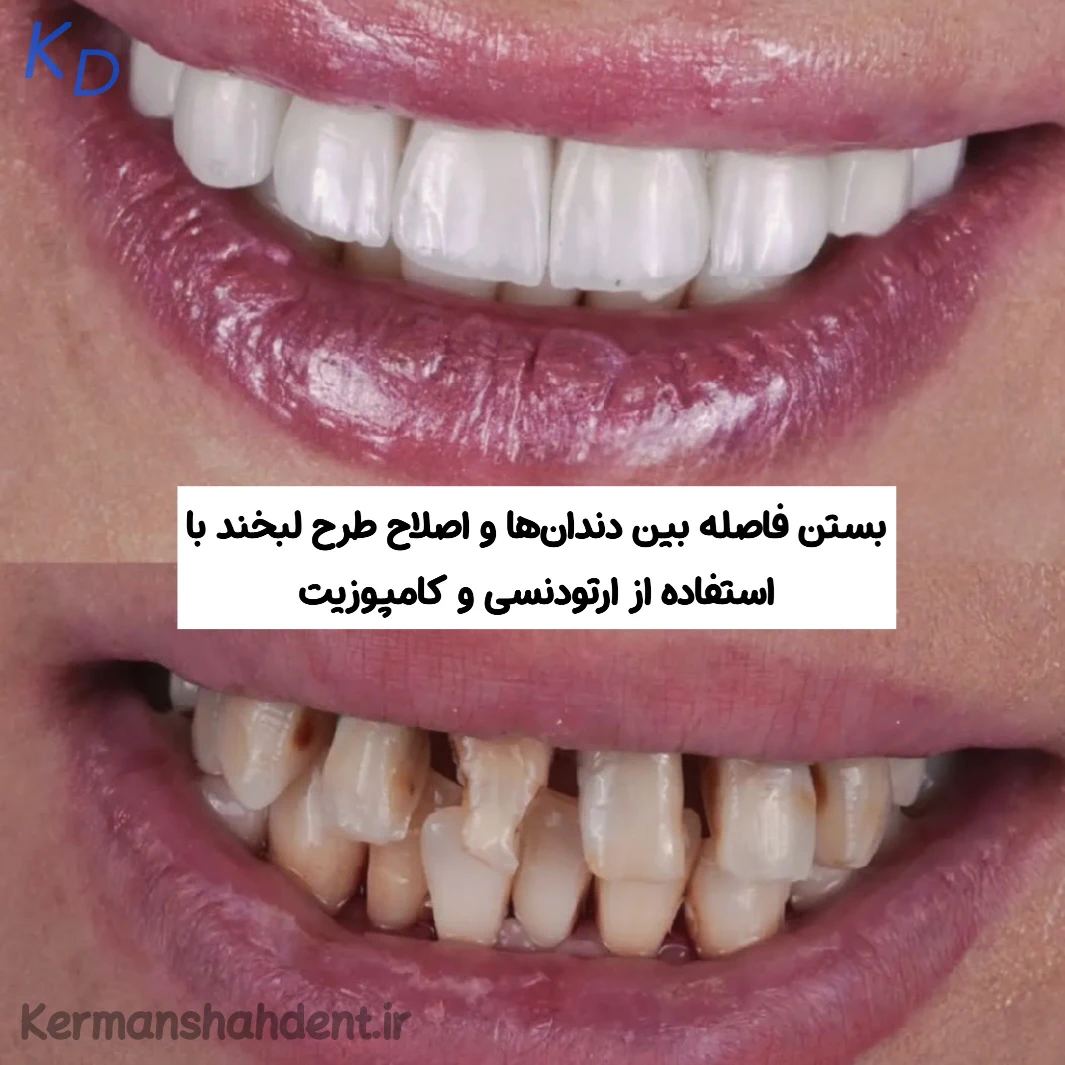 بستن فاصله دندان با ارتودنسی