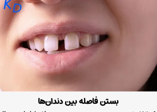بستن فاصله بین دندان ها