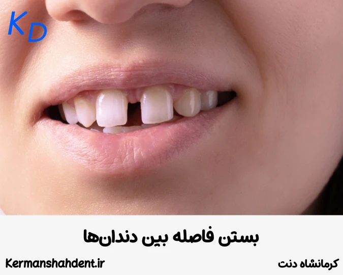 بستن فاصله بین دندان ها