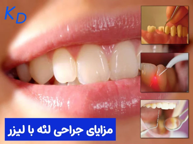 مزایای جراحی لثه با دستگاه لیزر