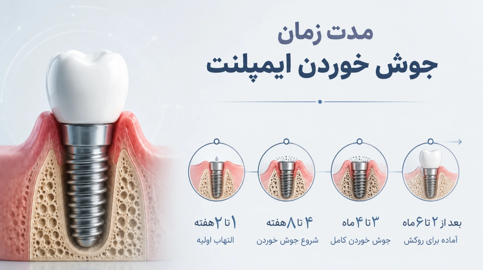 مدت زمان جوش خوردن ایمپلنت