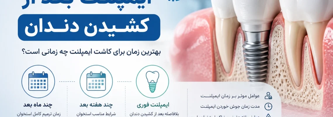 مدت زمان ایمپلنت بعد از کشیدن دندان