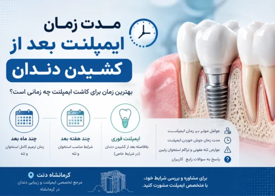 مدت زمان ایمپلنت بعد از کشیدن دندان