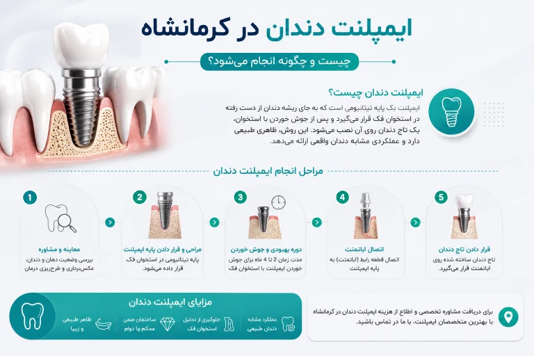 مراحل ایمپلنت دندان